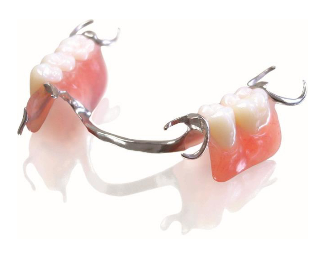 A partial denture with a metal framework