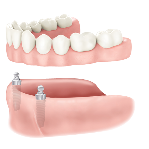 Illustration of removable dentures supported by implants